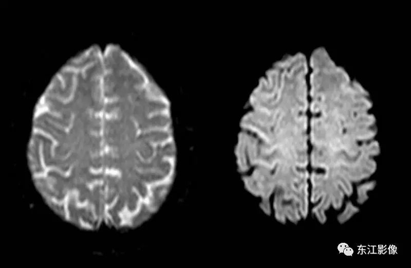 头颅mri检查多少钱_头颅mri_头颅mri平扫是检查什么的