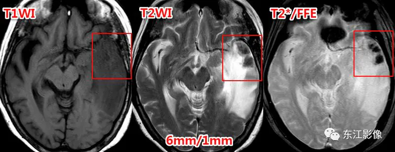 头颅mri平扫是检查什么的_头颅mri检查多少钱_头颅mri