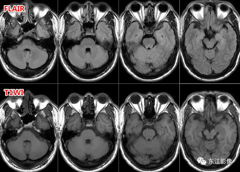 头颅mri平扫是检查什么的_头颅mri检查多少钱_头颅mri