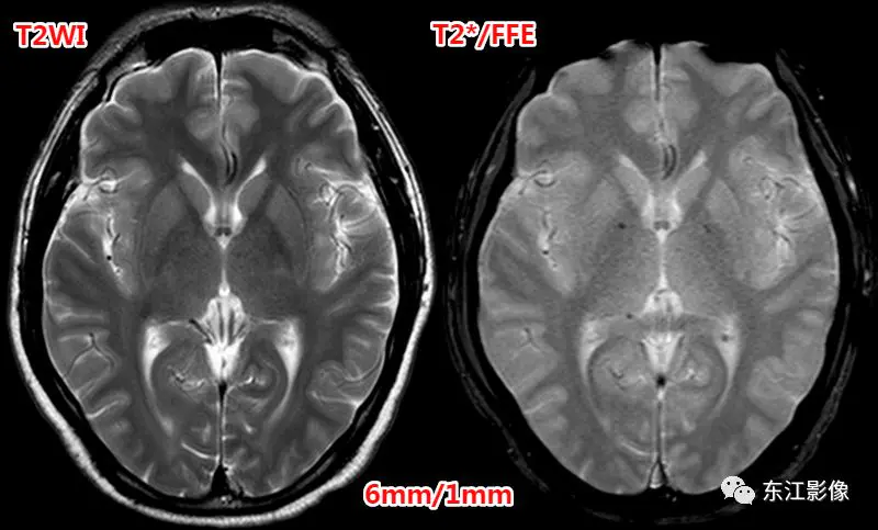 头颅mri检查多少钱_头颅mri_头颅mri平扫是检查什么的