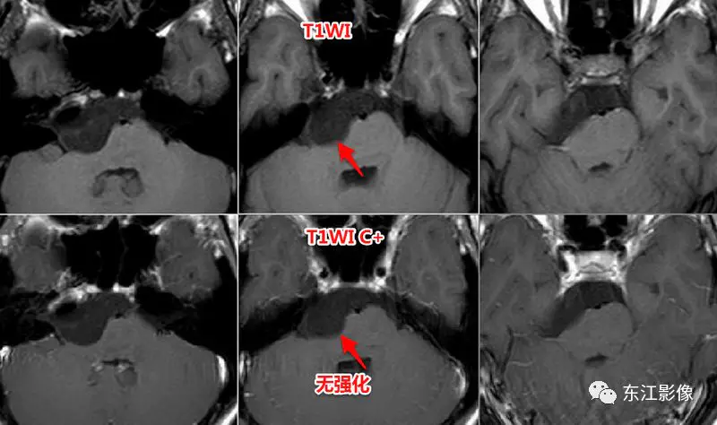 头颅mri平扫是检查什么的_头颅mri检查多少钱_头颅mri