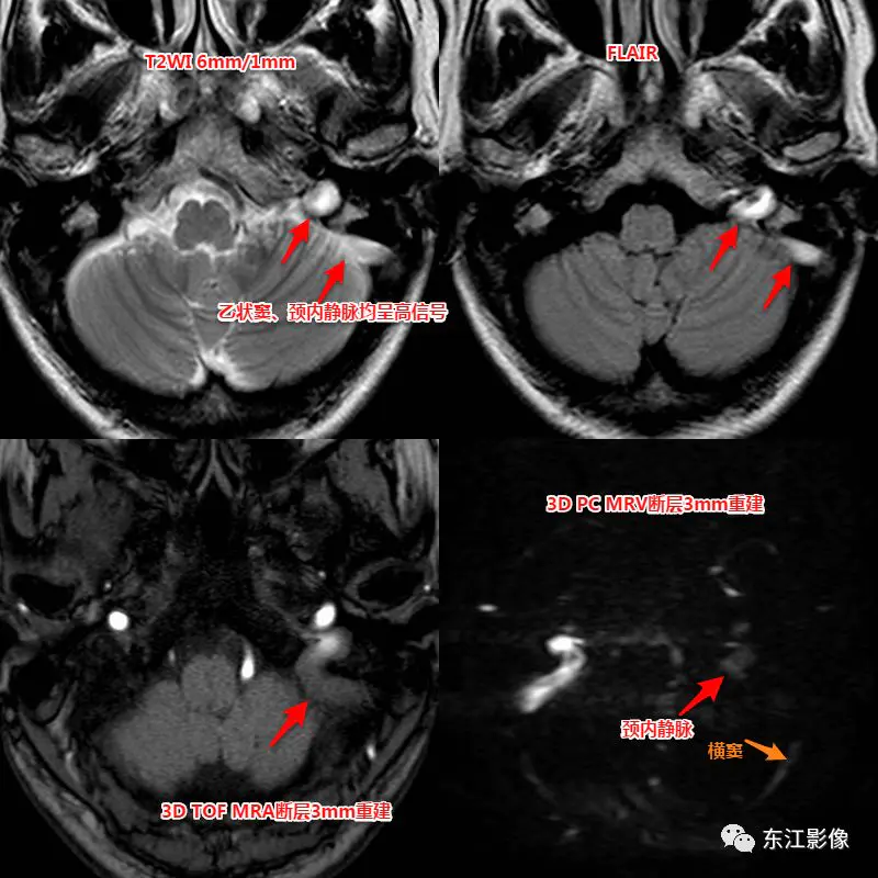 头颅mri检查多少钱_头颅mri_头颅mri平扫是检查什么的