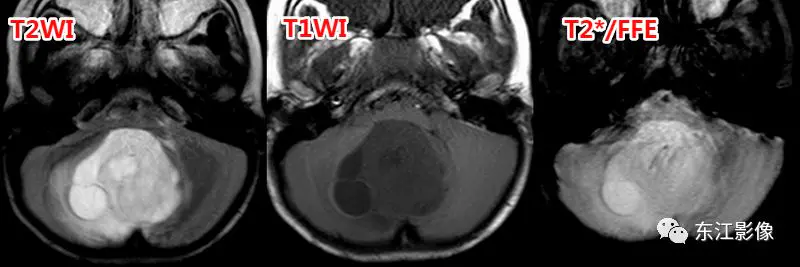 头颅mri_头颅mri检查多少钱_头颅mri平扫是检查什么的