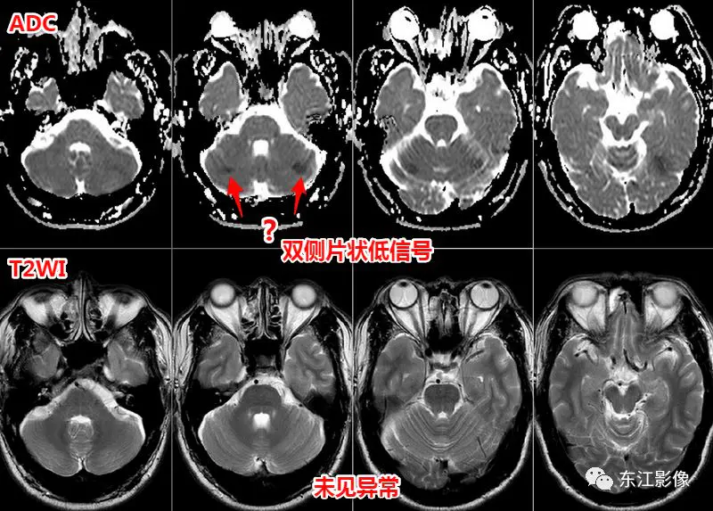 头颅mri检查多少钱_头颅mri_头颅mri平扫是检查什么的