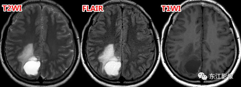 头颅mri_头颅mri检查多少钱_头颅mri平扫是检查什么的