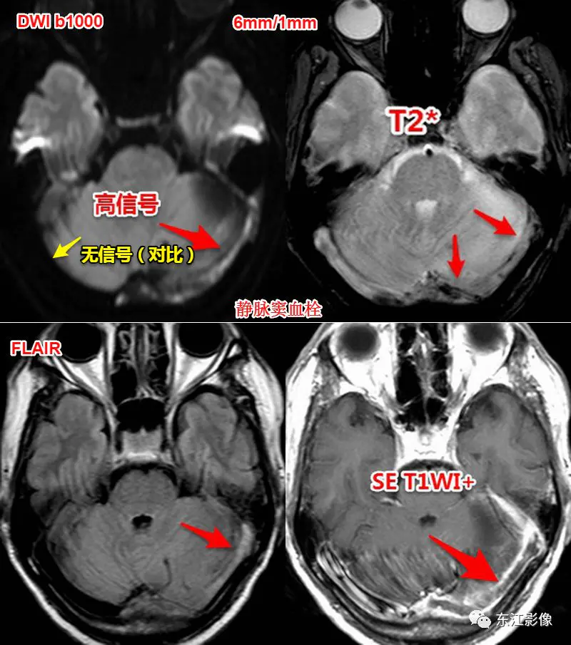 头颅mri检查多少钱_头颅mri_头颅mri平扫是检查什么的