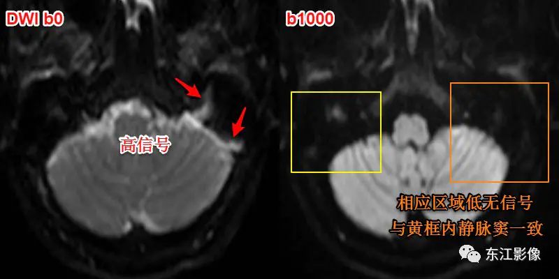 头颅mri_头颅mri检查多少钱_头颅mri平扫是检查什么的