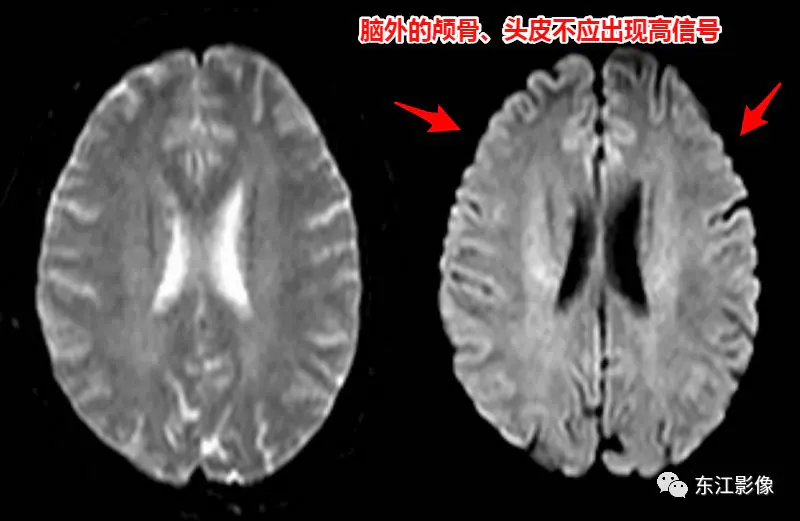 头颅mri_头颅mri检查多少钱_头颅mri平扫是检查什么的