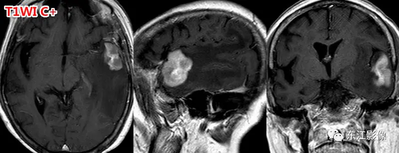 头颅mri检查多少钱_头颅mri_头颅mri平扫是检查什么的