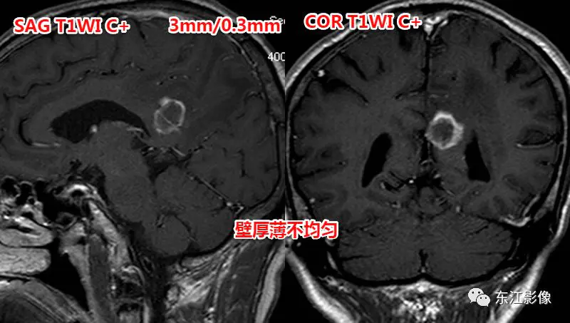 头颅mri检查多少钱_头颅mri平扫是检查什么的_头颅mri