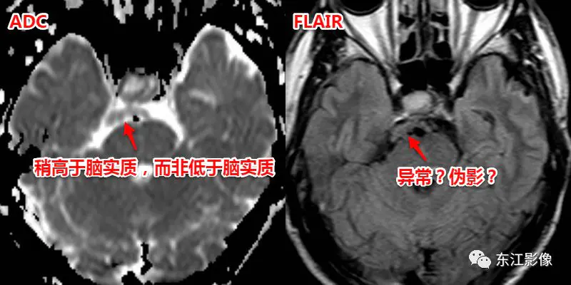 头颅mri平扫是检查什么的_头颅mri检查多少钱_头颅mri